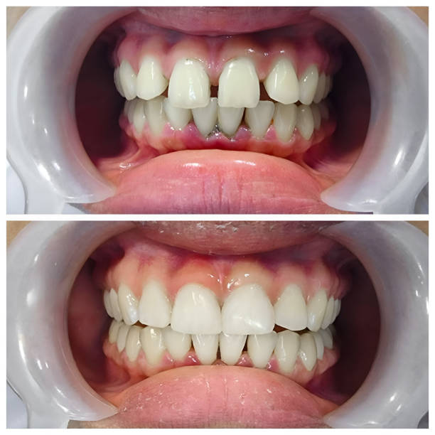 Best Full Mouth Reconstruction  in Murphy, NC